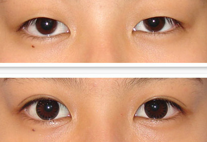 宁波双眼皮修复哪个医生比较好?宁波双眼皮修复专家排名名单推荐